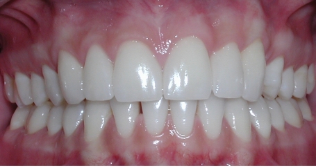 Smile with perfectly spaced teeth